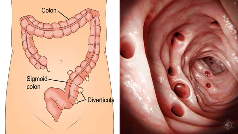 diverticulitis