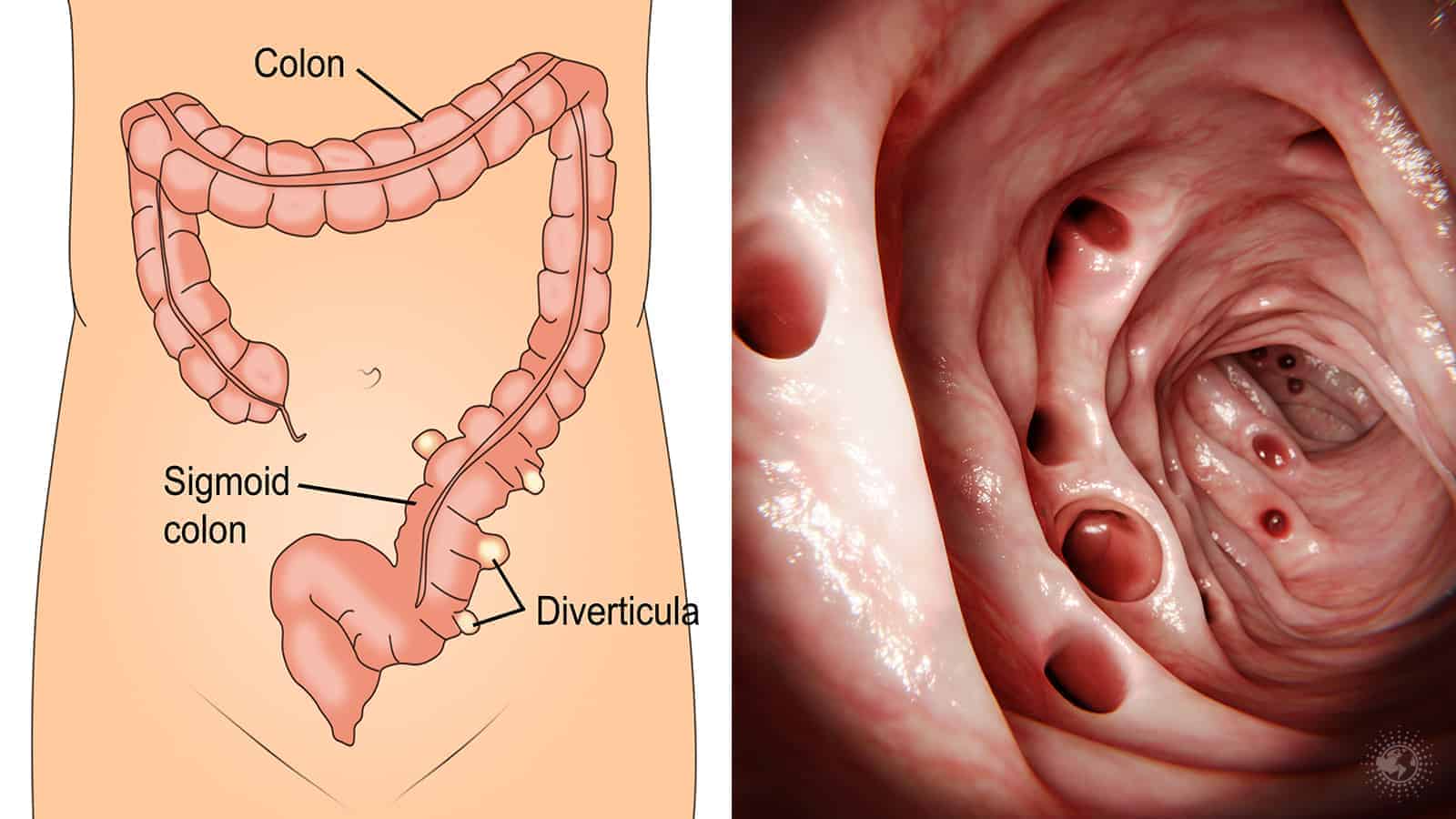 7 Symptoms of Diverticulitis (And Natural Remedies To Help Fix It)