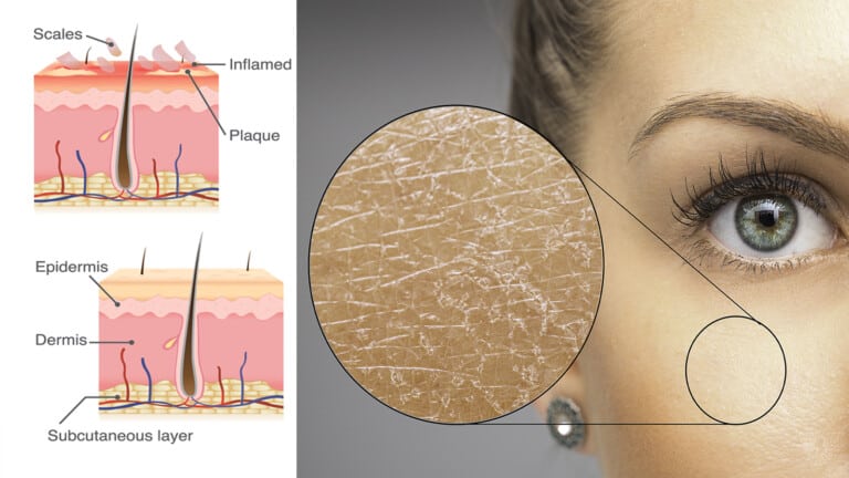 heal flaky skin