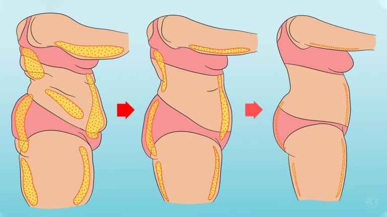 cellulite