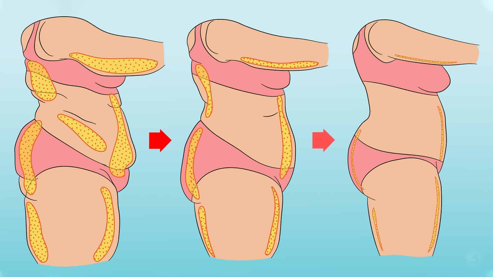 10 Easy Ways to Melt Away Cellulite Naturally
