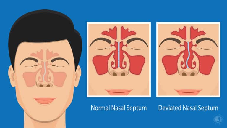 deviated septum