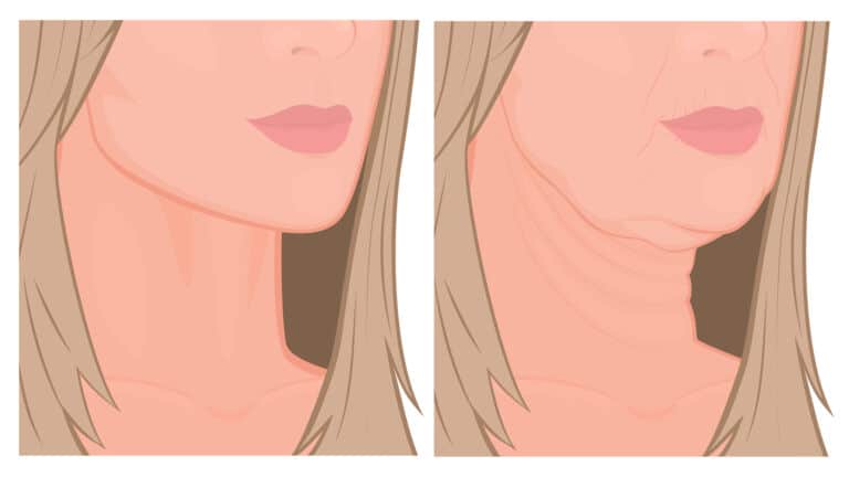 sagging jowls