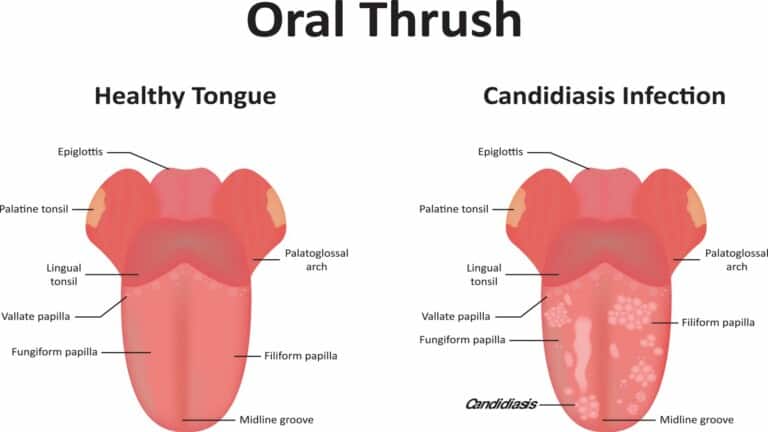 oral thrush