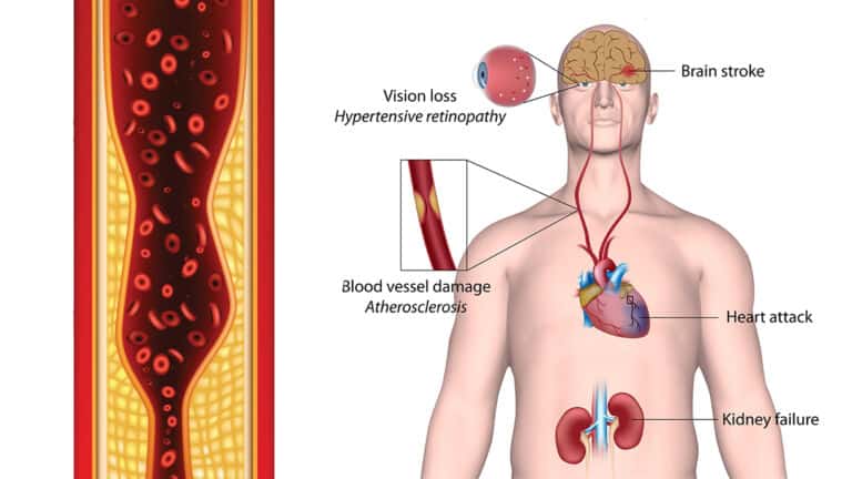 hypertension causes