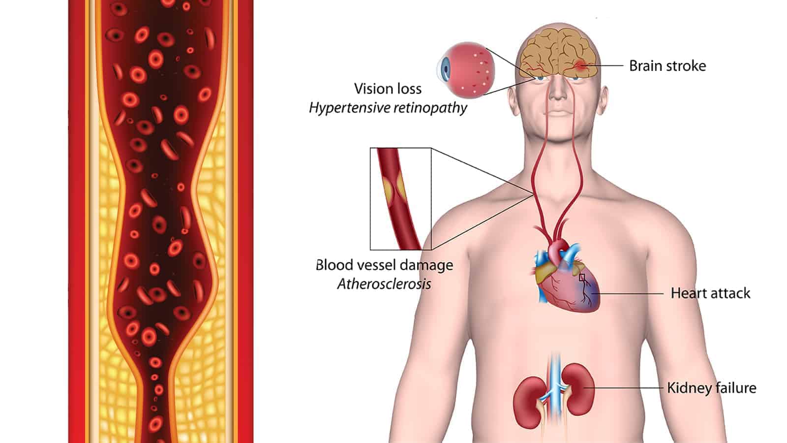 10 Causes of Hypertension Never to Ignore