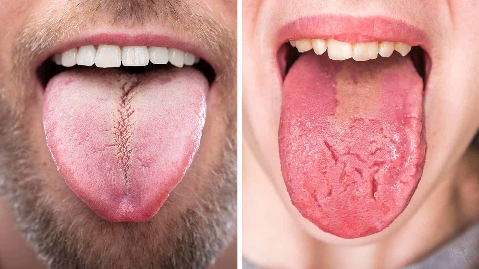 11 Things Your Tongue Can Tell You About Your Health