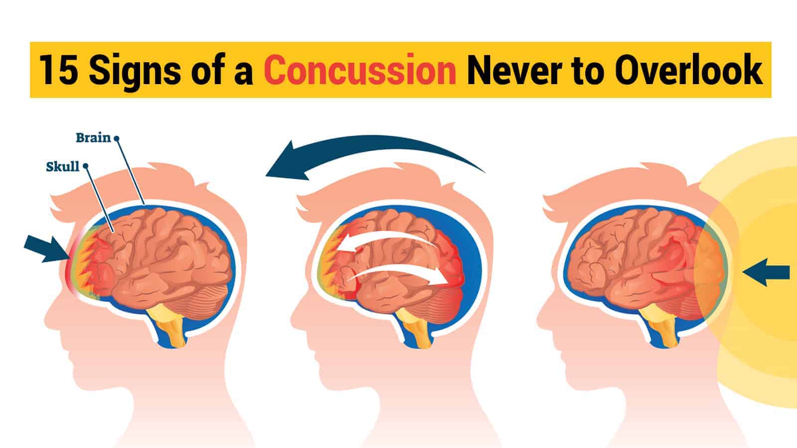 15 Signs of a Concussion Never to Overlook