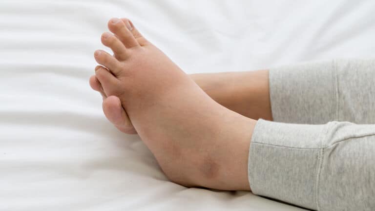 cankles