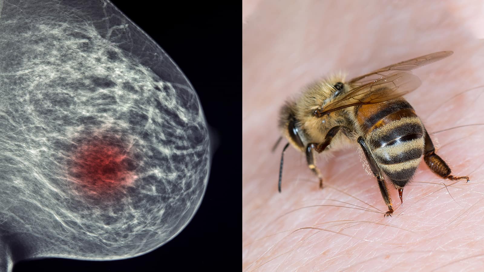 Research Reveals How Honeybee Venom Can Help Beat Breast Cancer