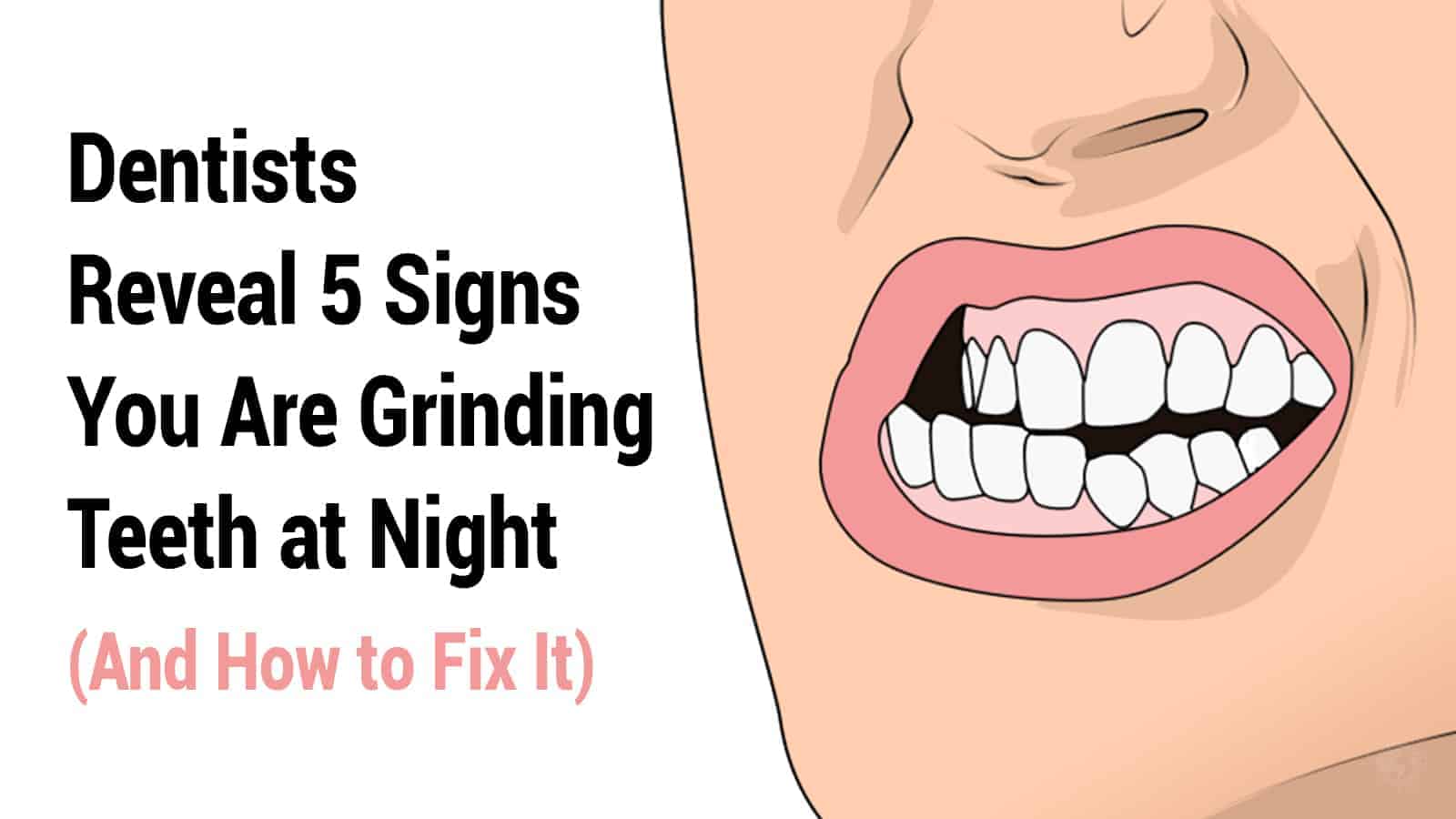 Dentists Reveal 5 Signs You Are Grinding Teeth at Night (And How to Fix It)