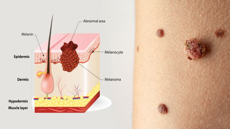 melanoma symptoms