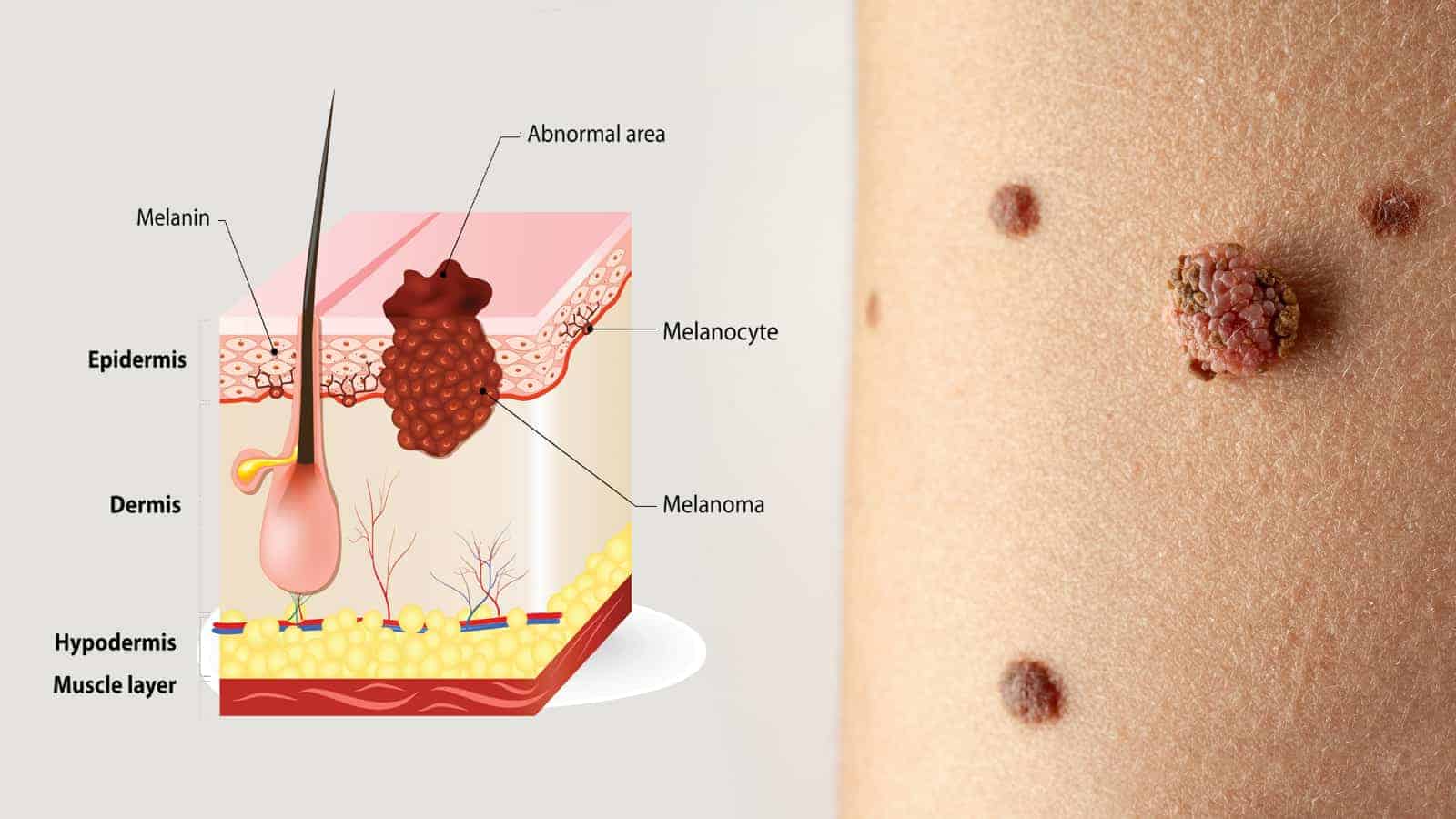 Dermatologists Explain 12 Melanoma Symptoms That Most People Miss