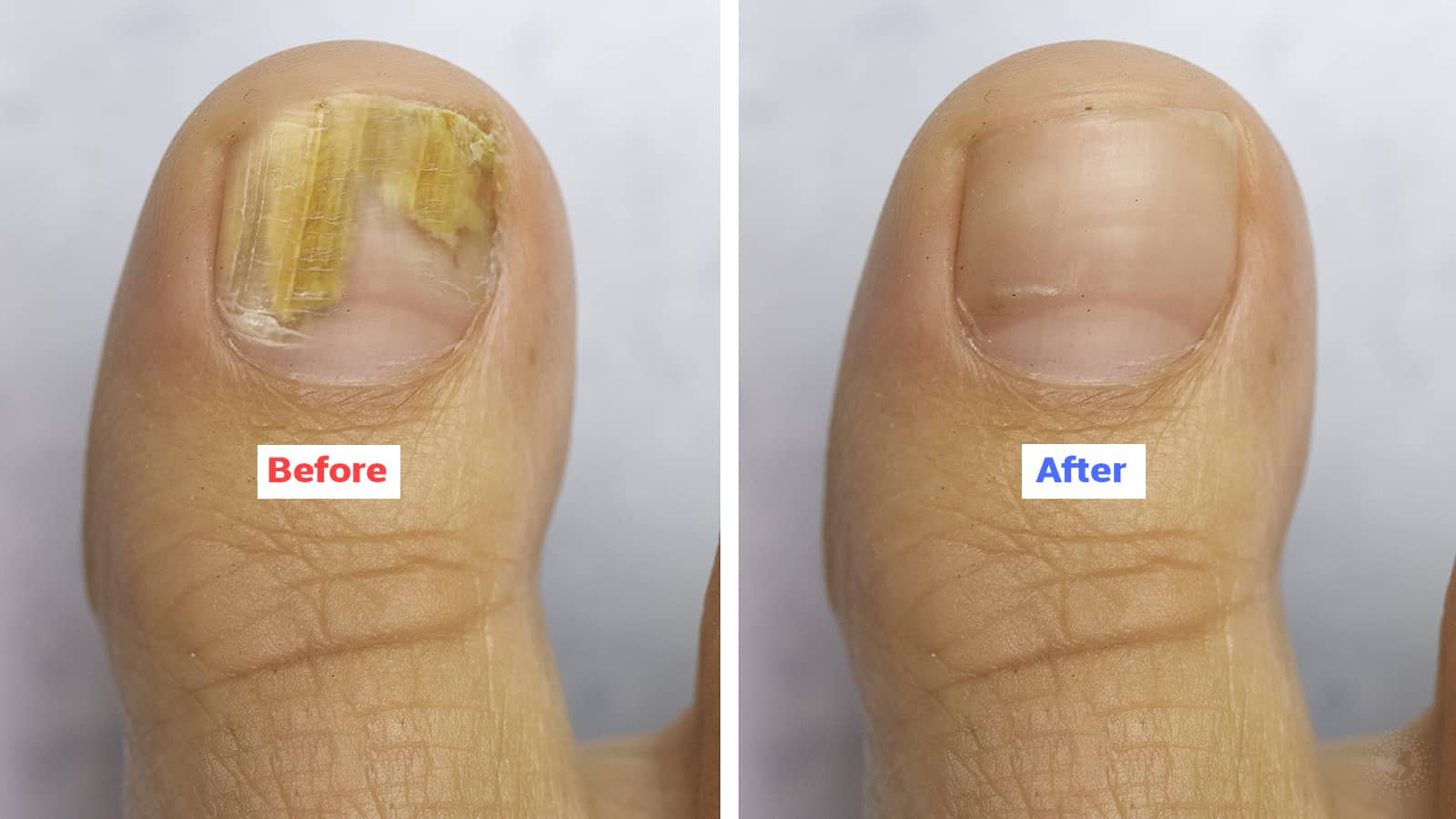 Dermatologists Explain the Cause of Nail Fungus (and How to Fix It)