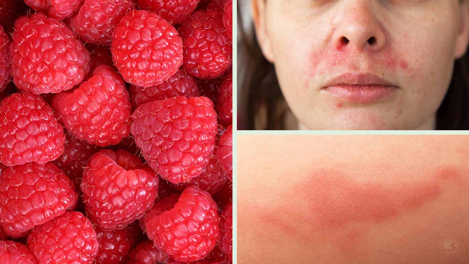 Study Reveals Raspberries Can Help Reduce Skin Inflammation