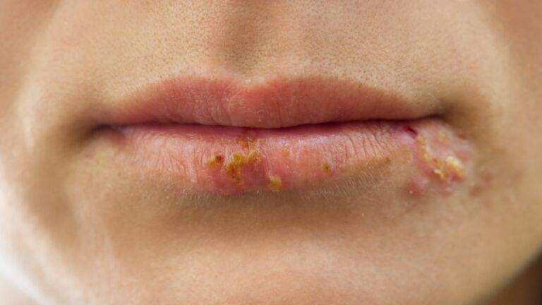 fever blister