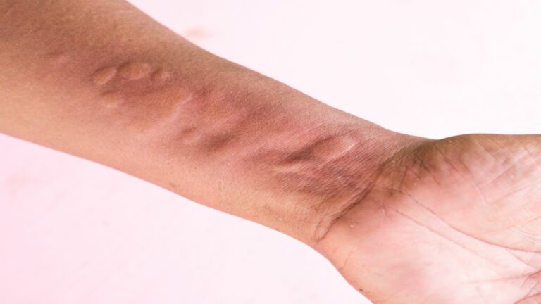 hives