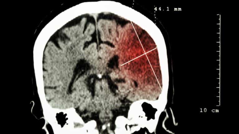 ischemic stroke