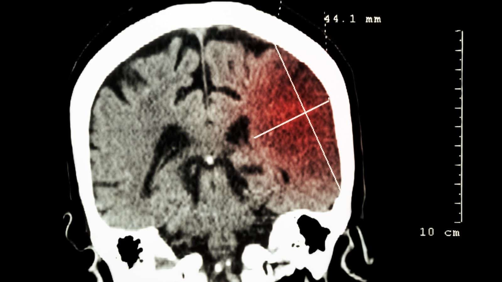 9 Warning Signs of an Ischemic Stroke Never to Ignore