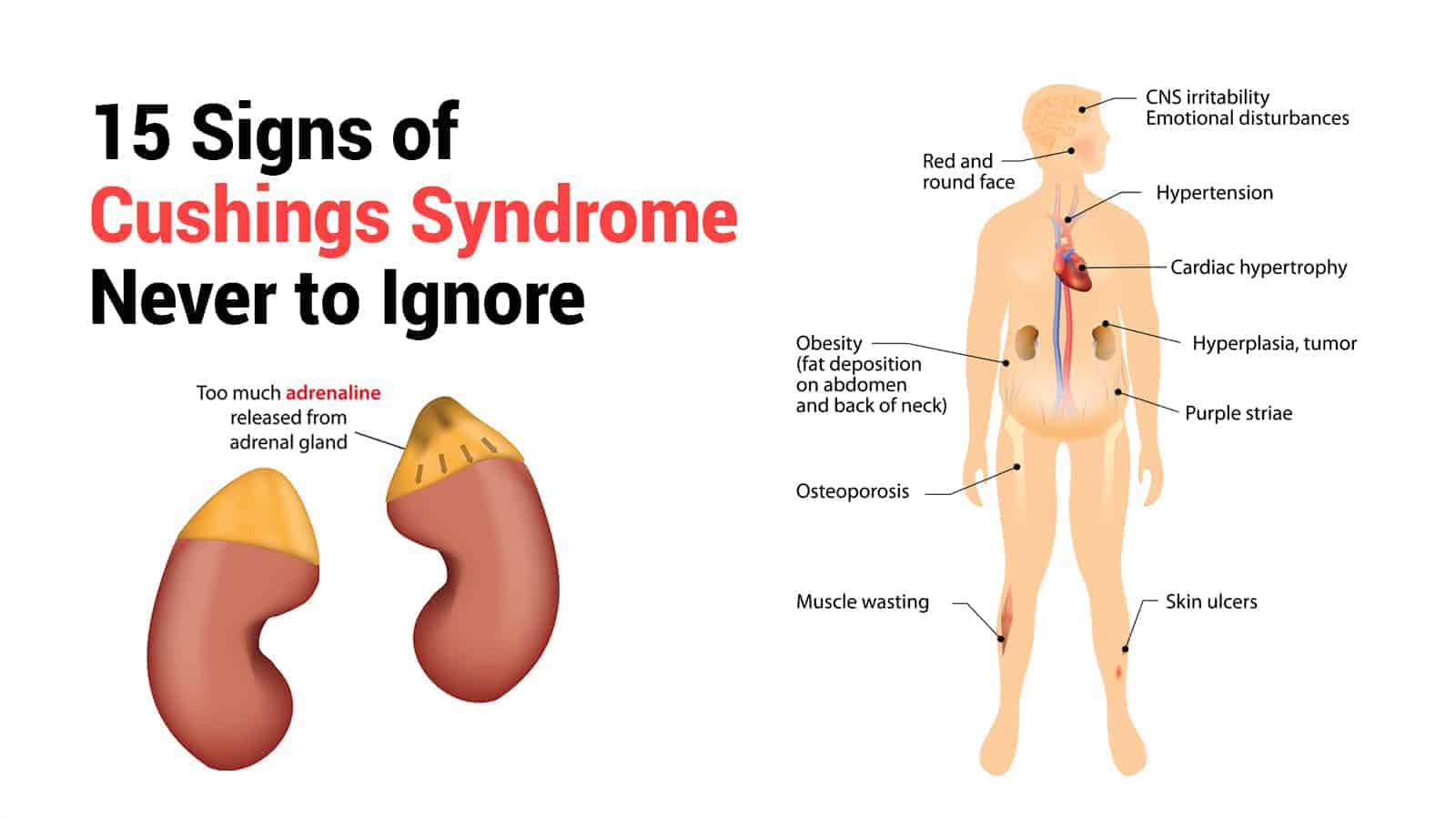 15 Signs of Cushings Syndrome Never to Ignore