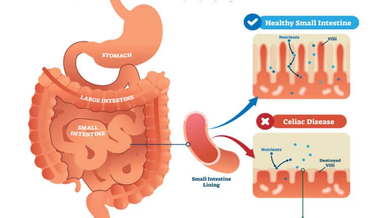 celiac disease