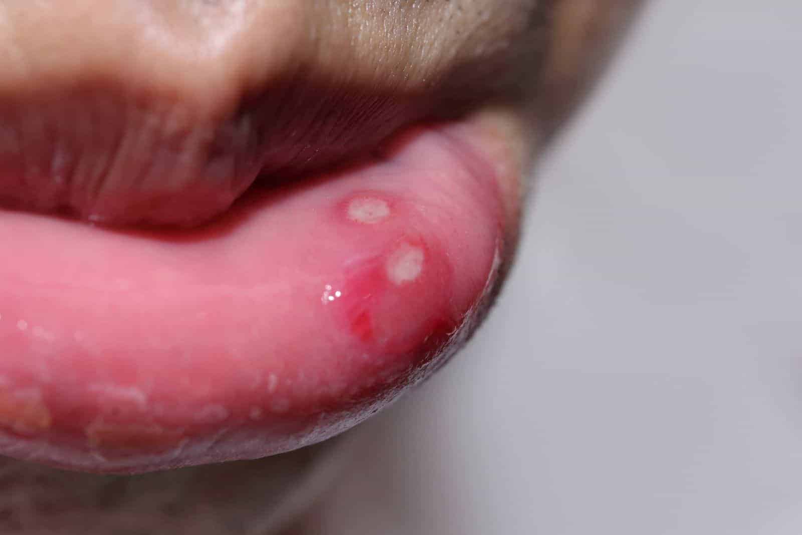 Dentists Explain the Cause of Canker Sores (and How to Fix It)