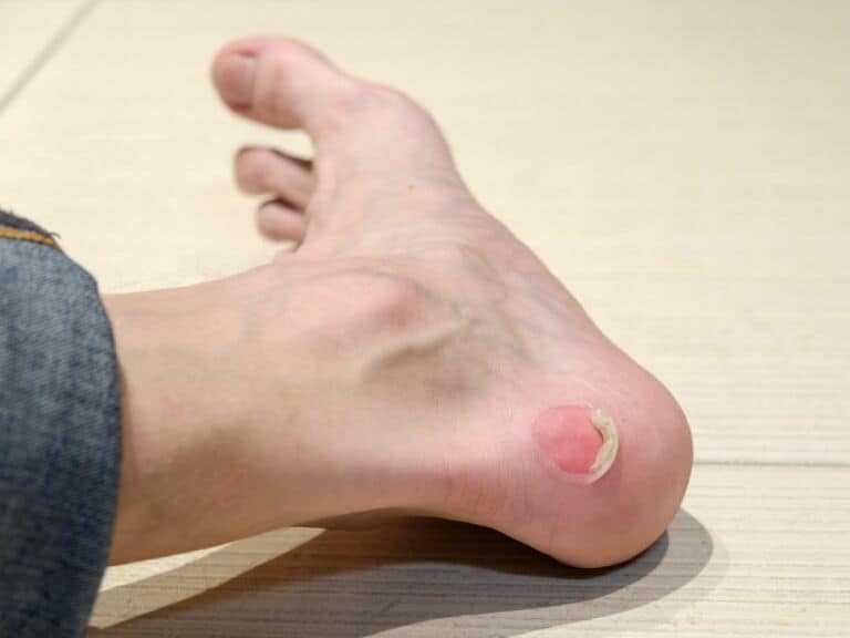 blisters