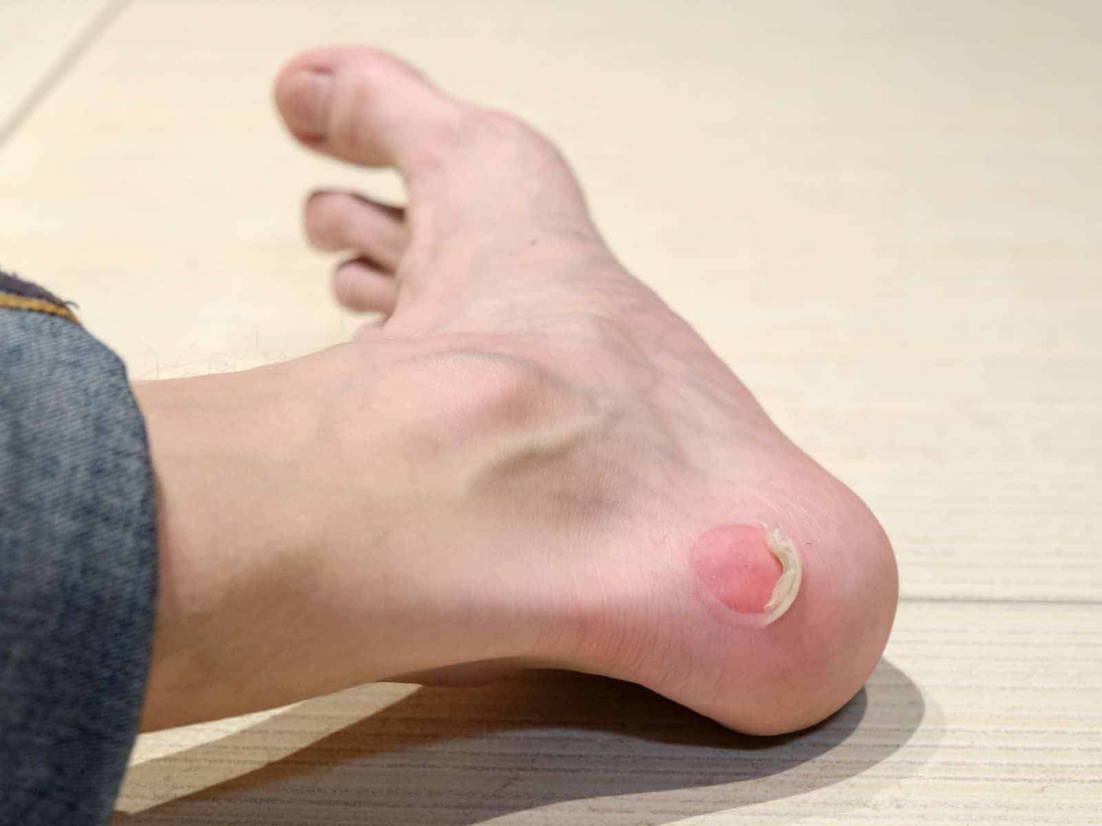 6 Easy Ways to Prevent Foot Blisters + What to Do if It’s Too Late