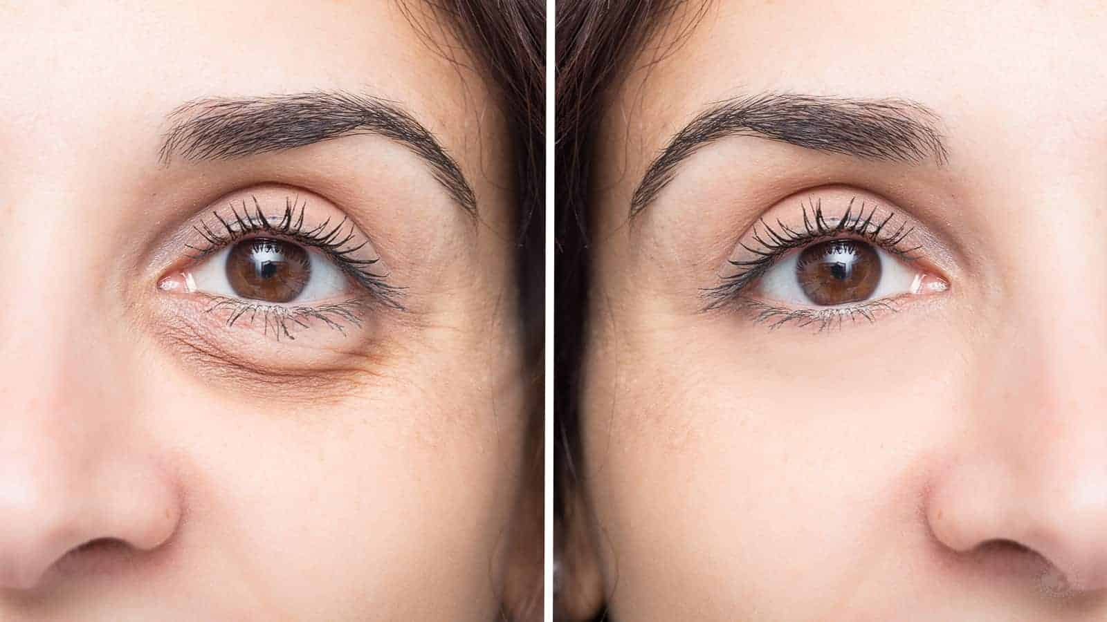 10 Causes of Dark Under-Eye Circles (And How to Get Rid Of Them)