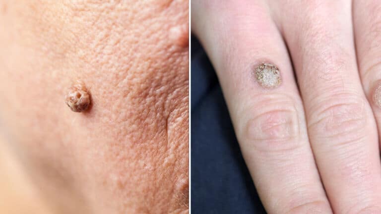 remove warts
