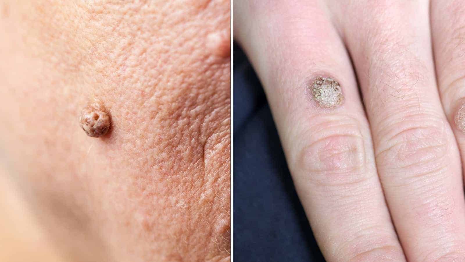 How to Remove Warts and Skin Tags Permanently