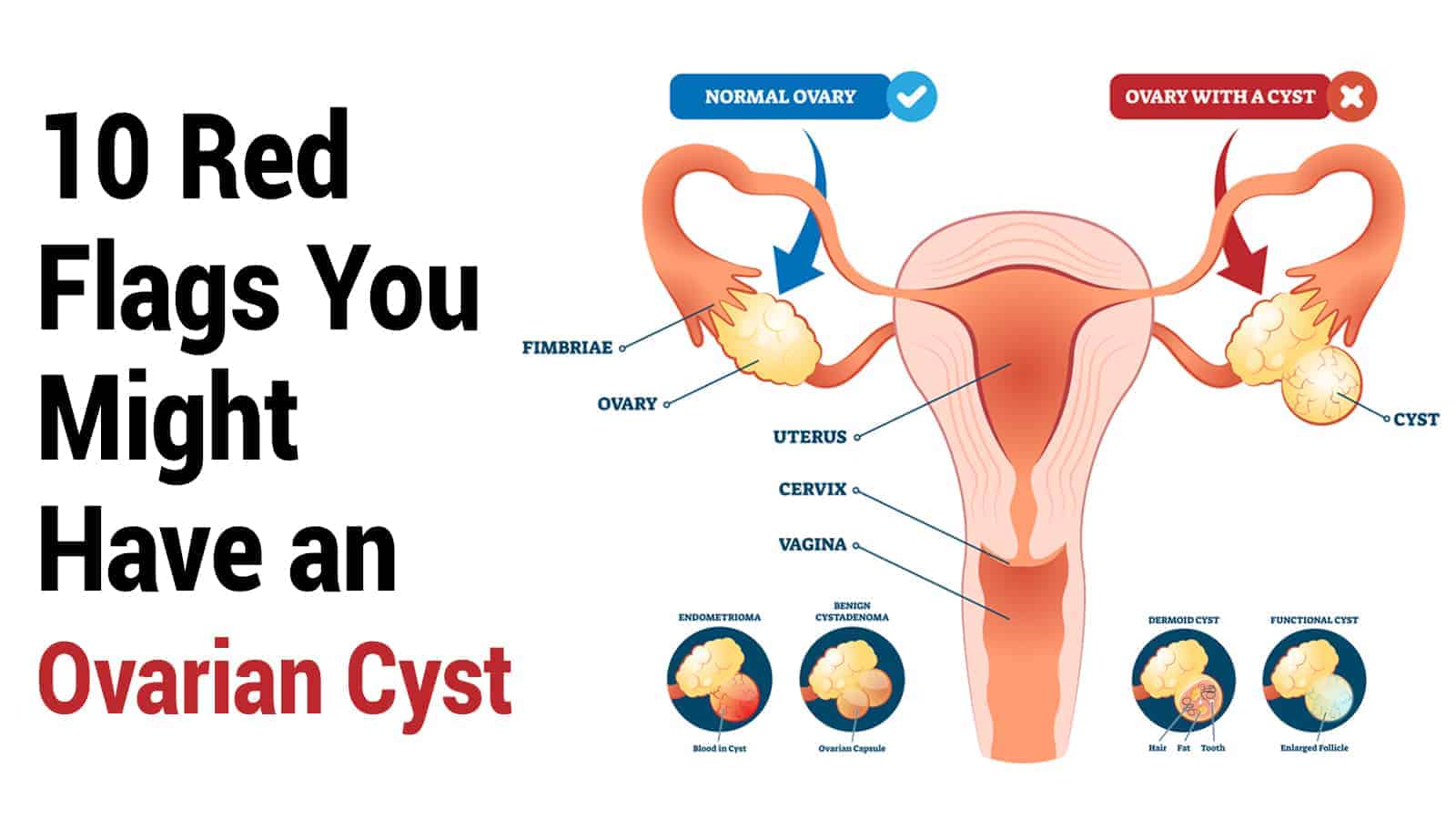 10 Red Flags You Might Have an Ovarian Cyst