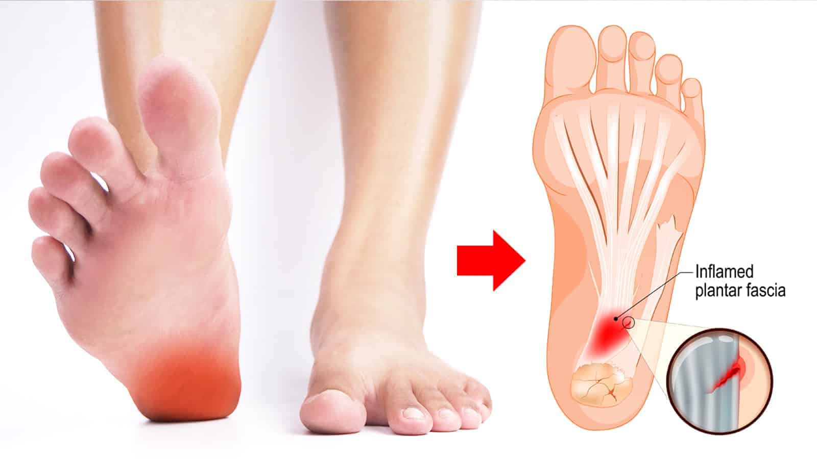 6 Plantar Fasciitis Stretches to Reduce Heel Pain