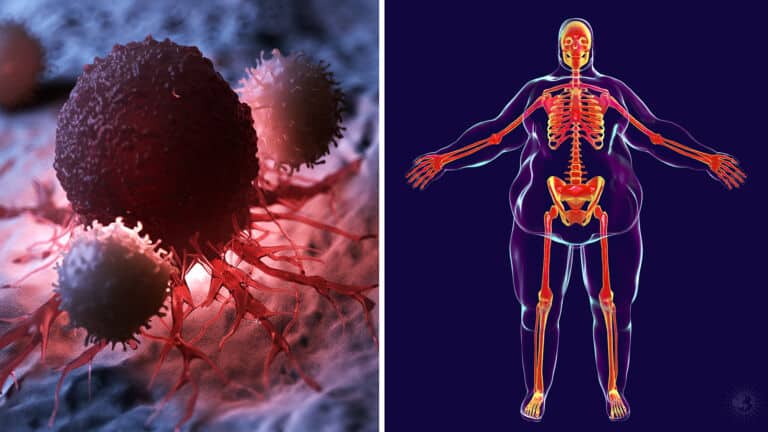 tumor growth obesity