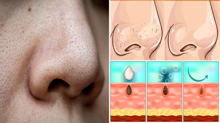 clogged pores