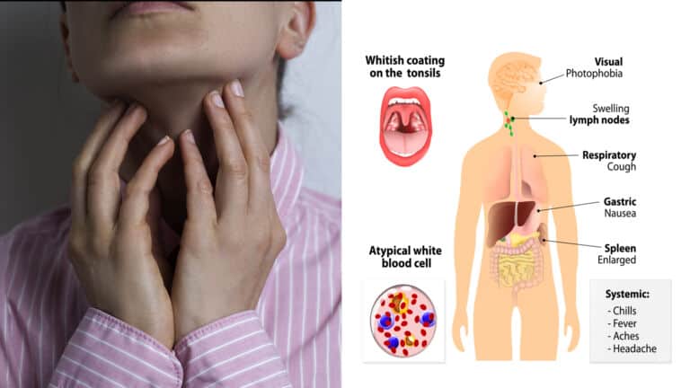 mononucleosis