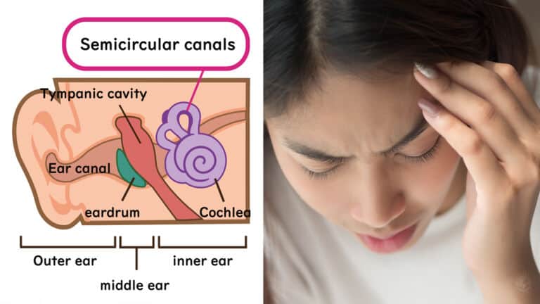 menieres disease