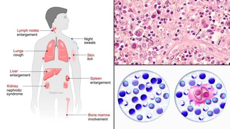 hodgkins lymphoma