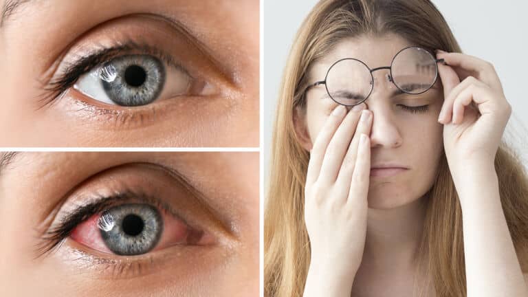 eye fatigue
