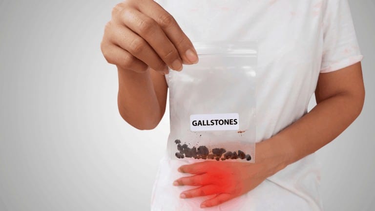 gallstones