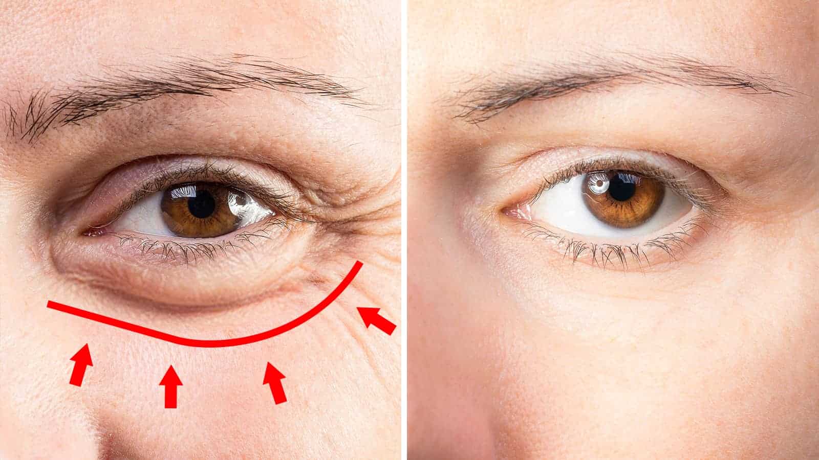 7 Habits That Cause Under Eye Puffiness (And How to Fix It)