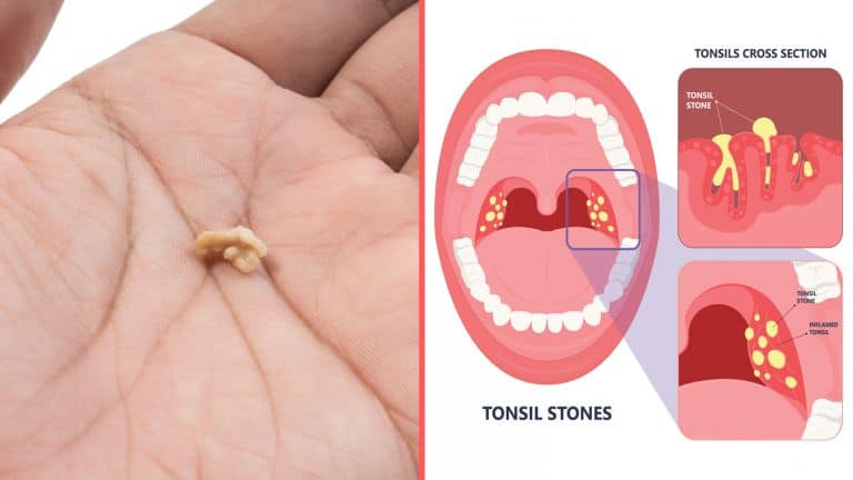 tonsil stones