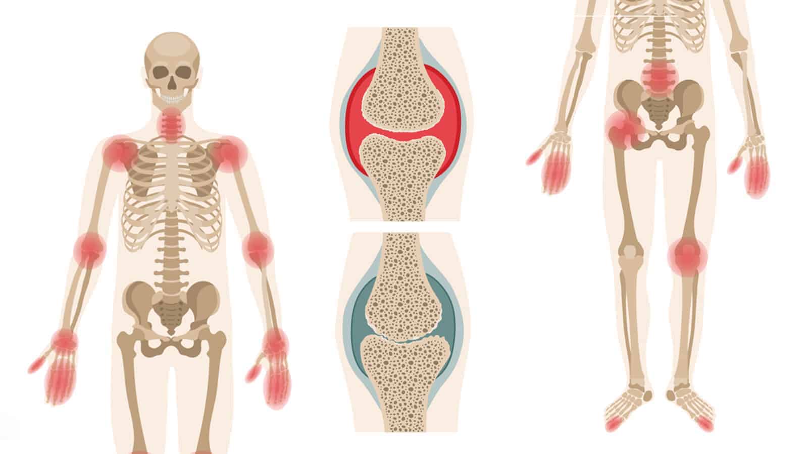 Study Finds Link Between Rheumatoid Arthritis and Osteoporosis