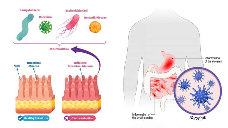 gastroenteritis