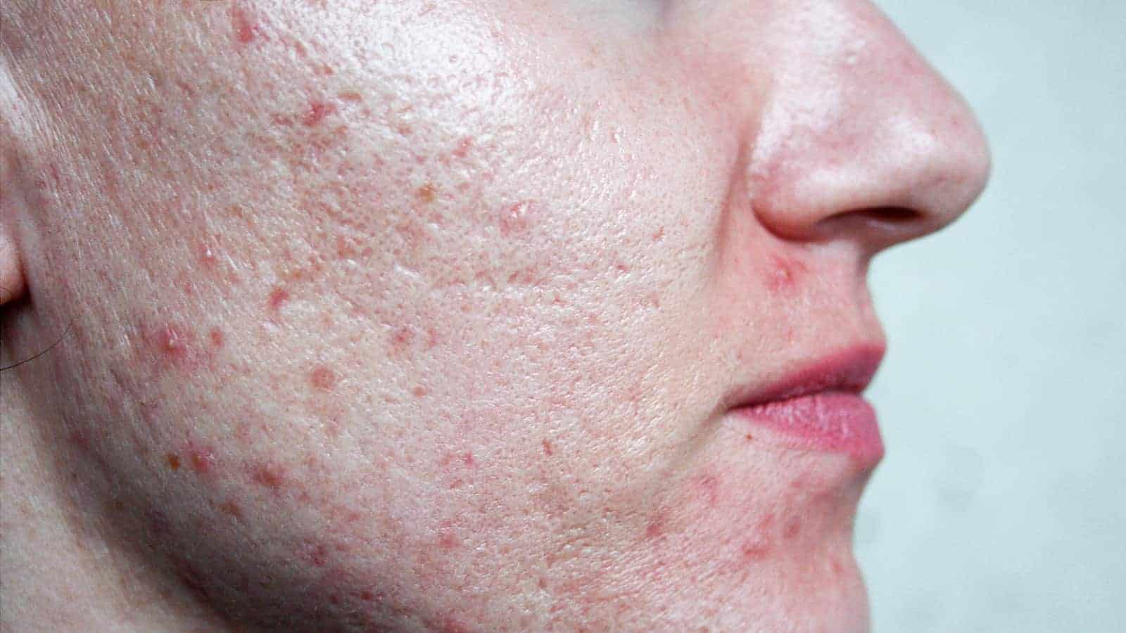 7 Habits That Cause Acne Scarring (and what to do instead)
