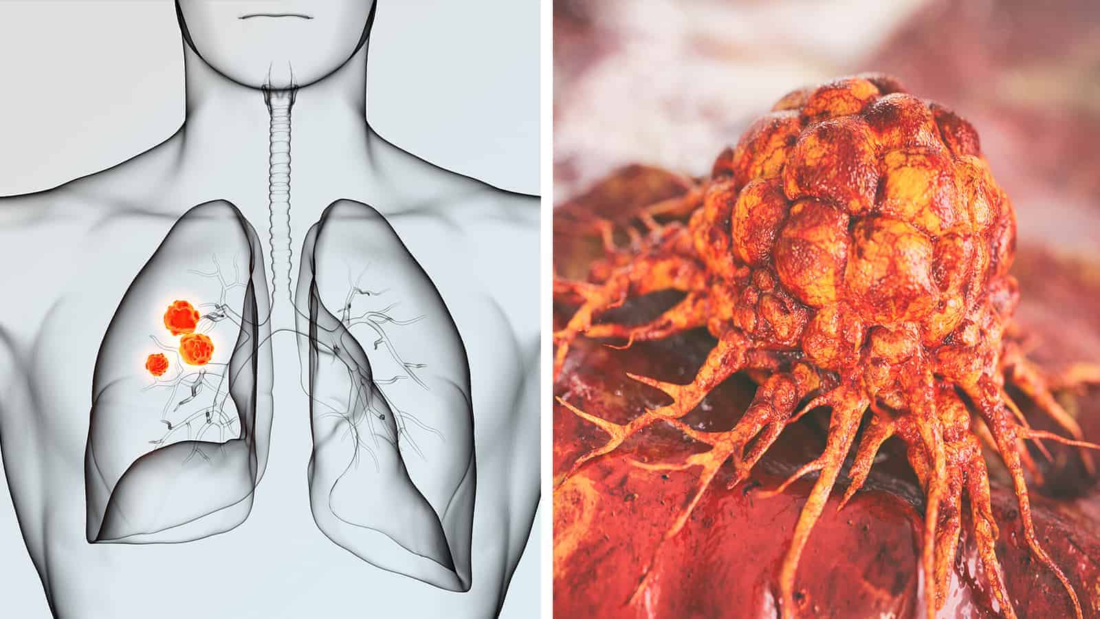 Oncologists Explain 13 Lung Cancer Symptoms to Never Ignore