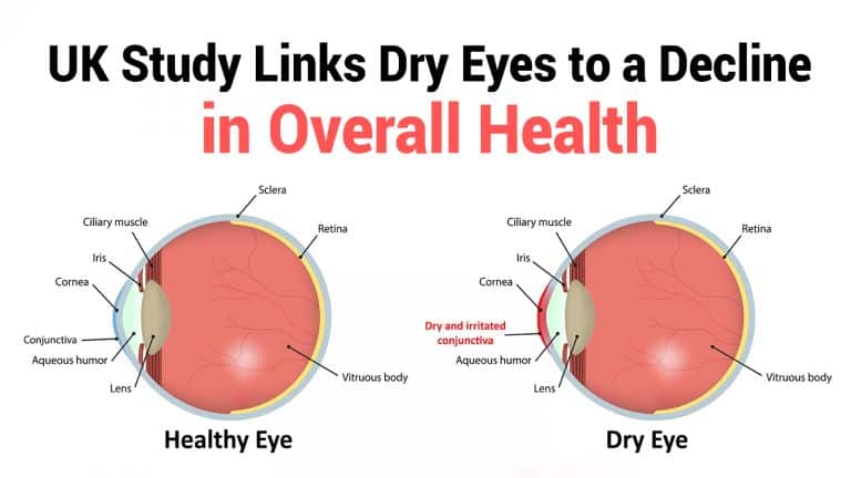 dry eyes