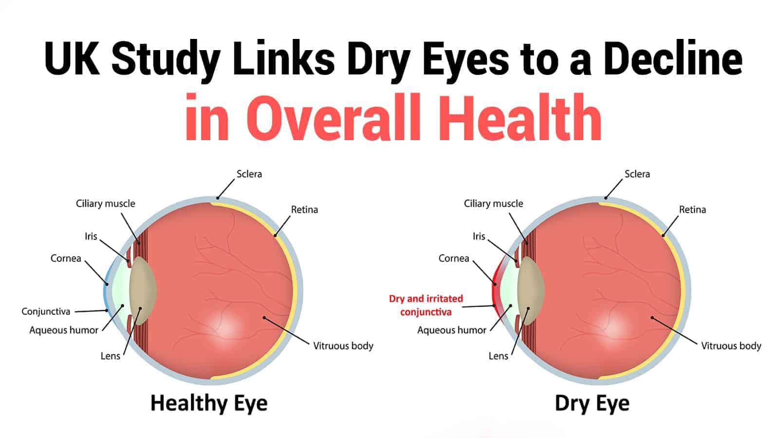 UK Study Links Dry Eyes to a Decline in Overall Health