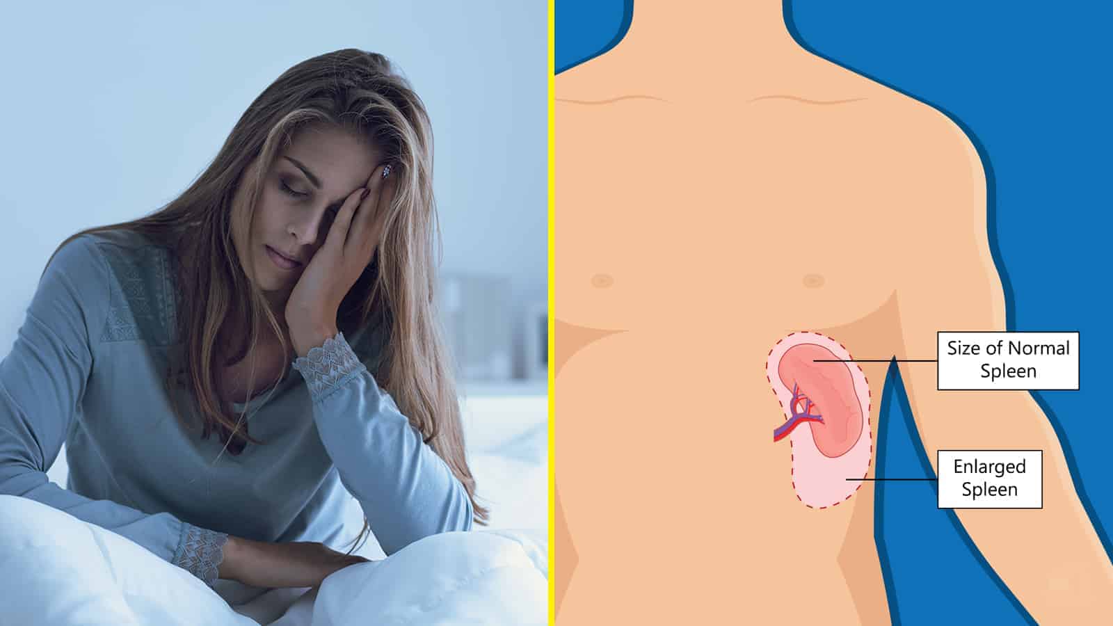 10 Red Flags You Might Have an Enlarged Spleen