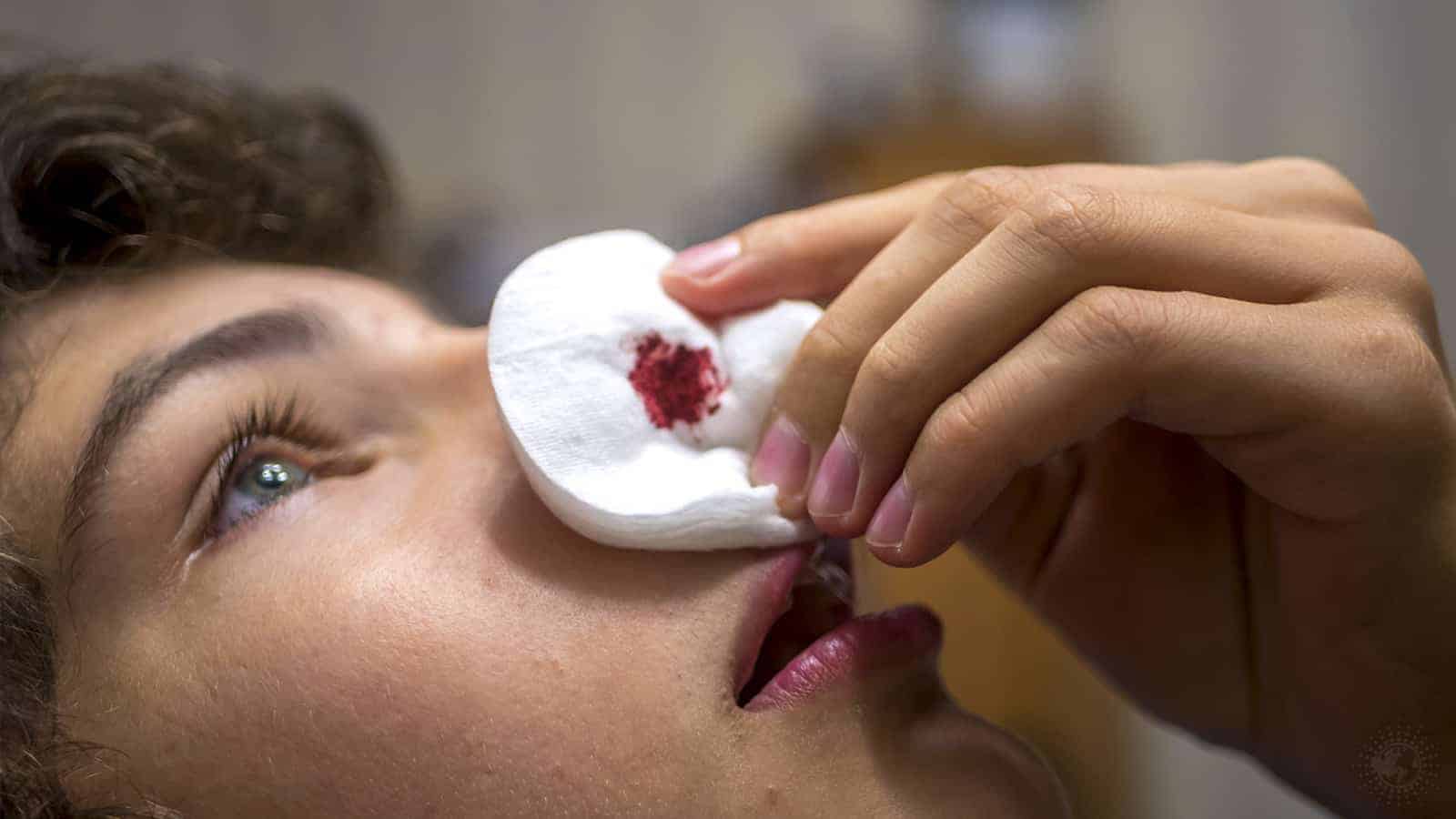 10 Things That Cause a Nosebleed (and How to Stop It)
